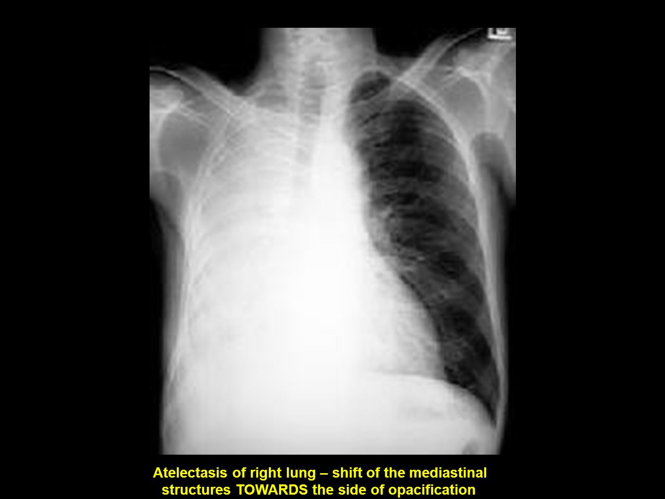Atelectasis x ray